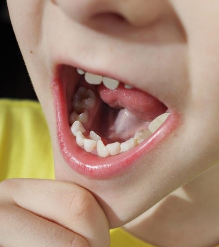 دندان اضافه در کودکان
